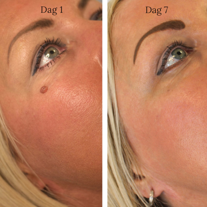 Zycon® | TagBuddy-set – Nooit meer huidtags