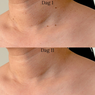 Zycon® | TagBuddy-set – Nooit meer huidtags