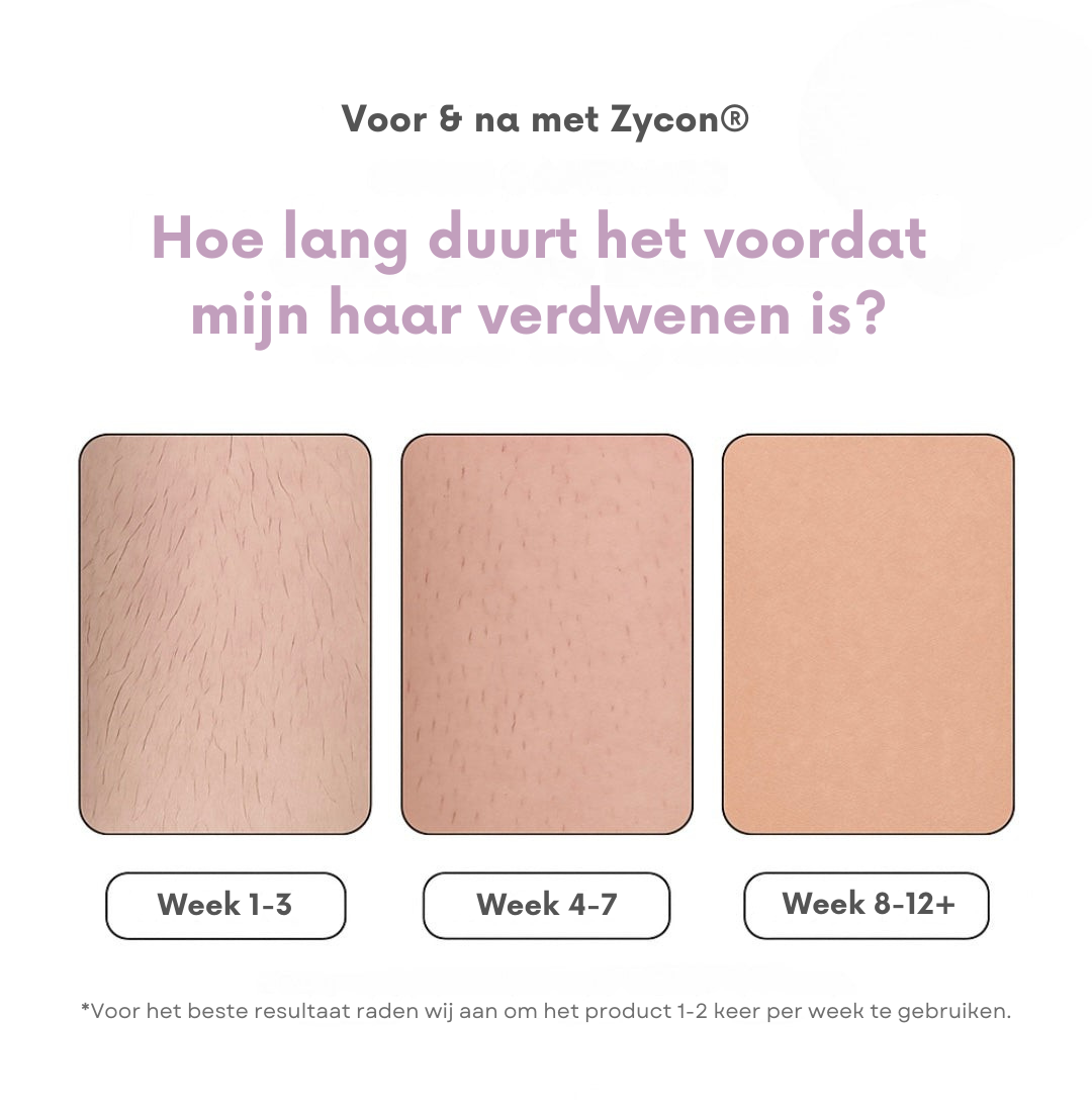 Zycon® IPL-ontharingsapparaat I De toonaangevende laserontharing voor thuis