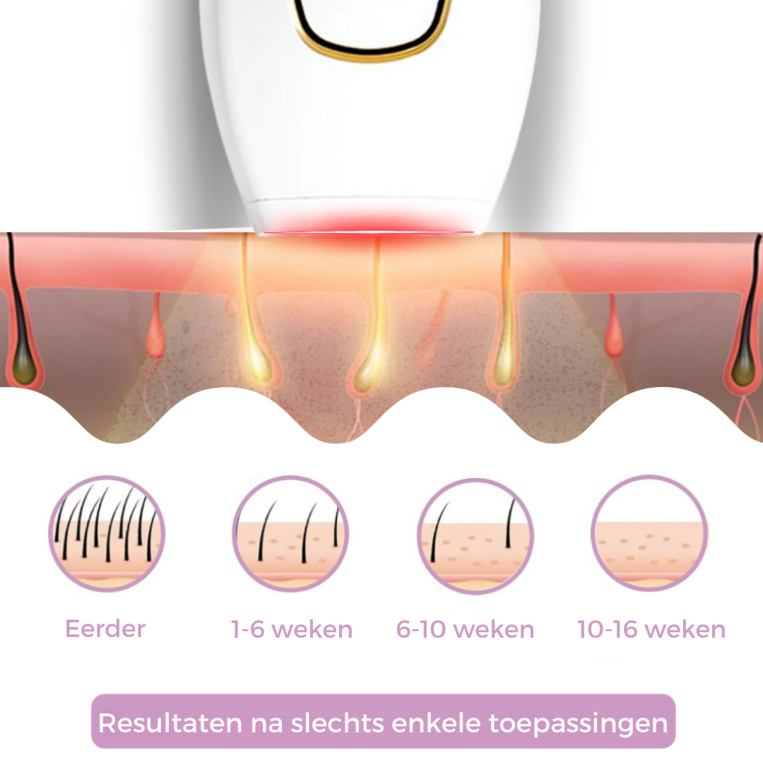 Zycon® IPL-ontharingsapparaat I De toonaangevende laserontharing voor thuis