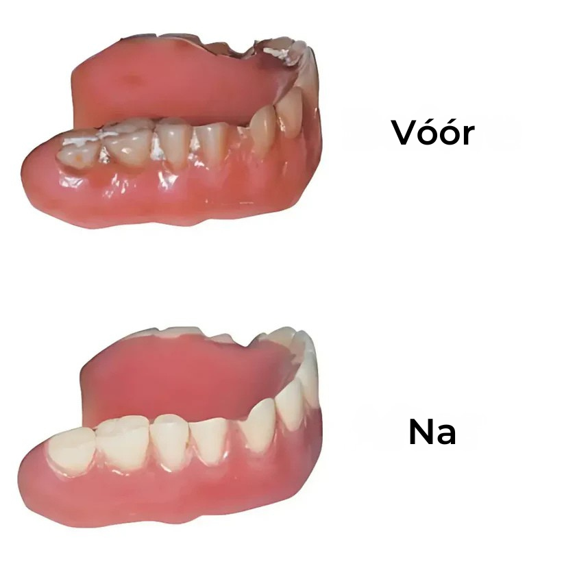 Zycon® Kunstgebit Reiniger – Dagelijkse Schoonmaak voor Prothese