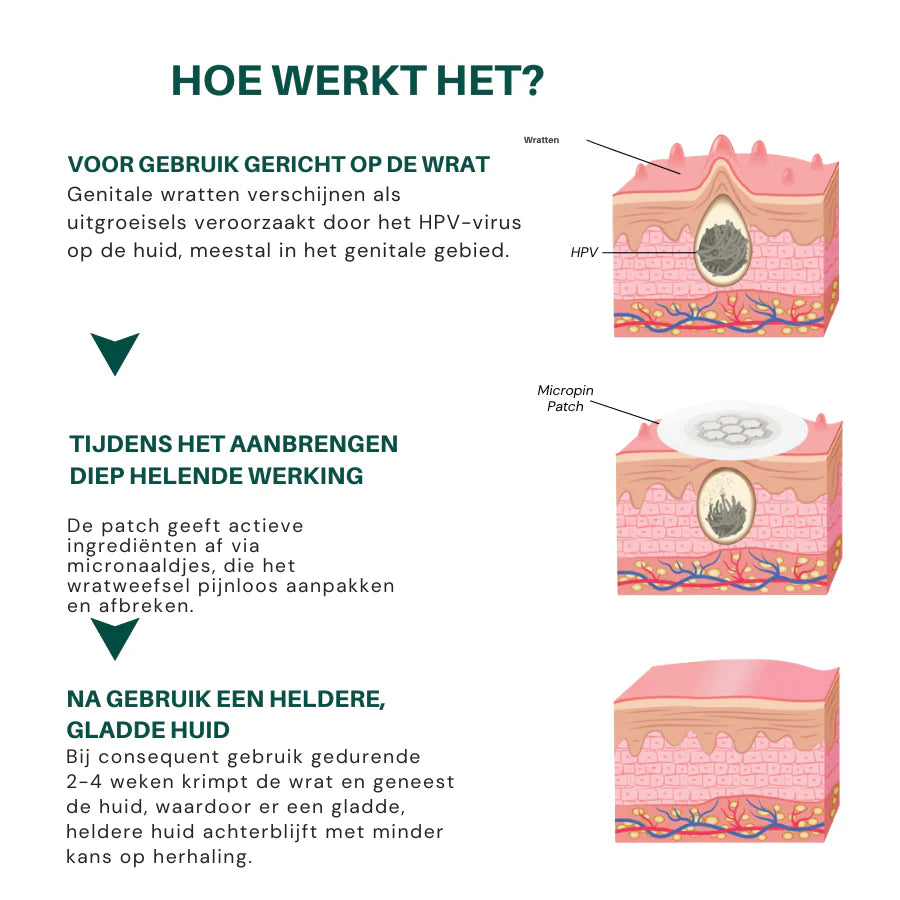 Zycon® Magnesium MicroPin HPV Genitale Wrat Verwijdering Patch